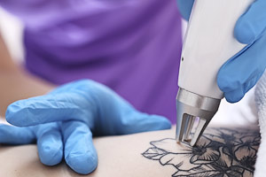 Tatooentfernung mit Laser - Hautarzt Dillingen